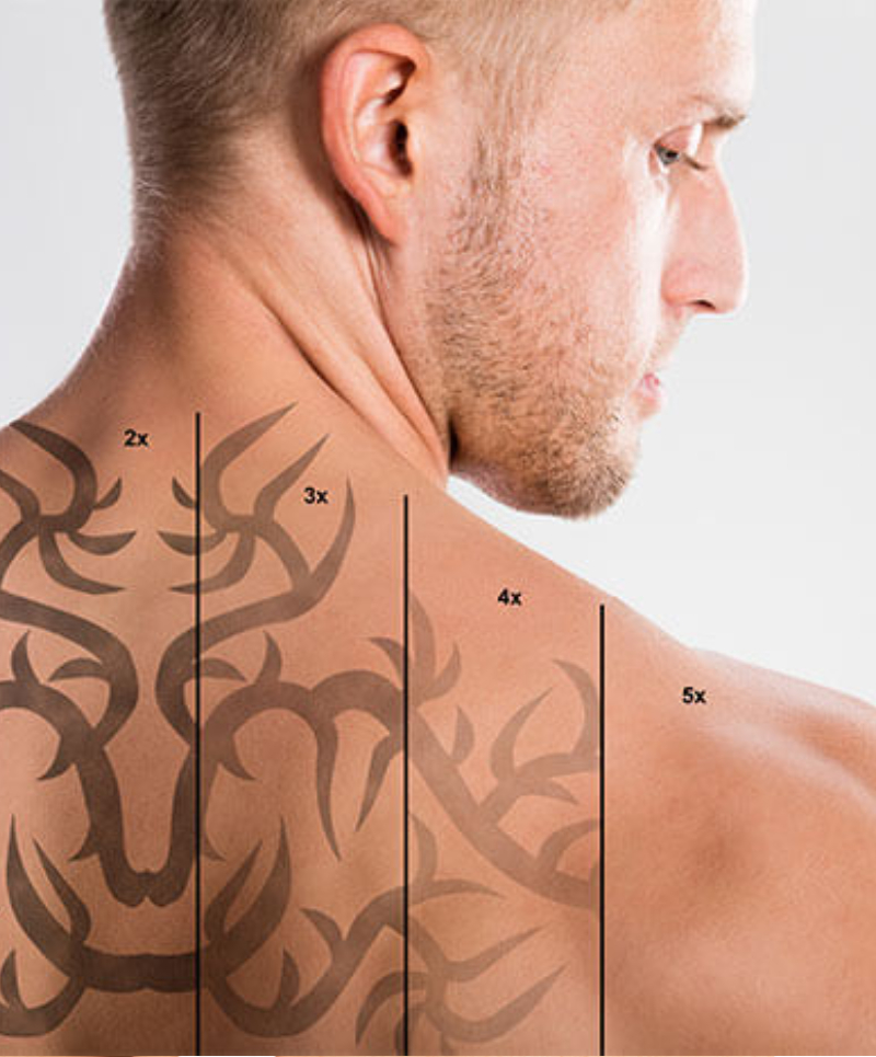 Laser Tattoo Removal in Kolkata - Dr. Poddar Aesthetic Clinic